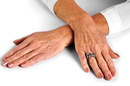 Skin of the hand with age-related changes requiring the use of rejuvenation techniques